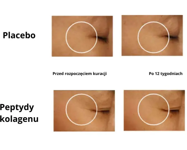 Porównanie efektów kolagenu do picia: skóra przed i po 12 tygodniach kuracji. Zmniejszenie zmarszczek wokół oka.