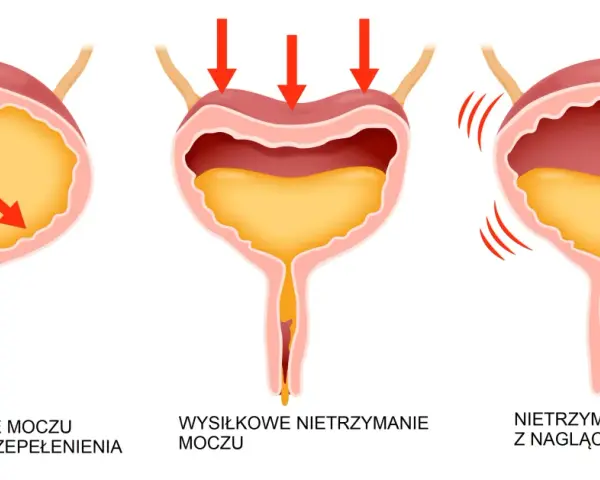 Ilustracja pokazuje różne rodzaje nietrzymania moczu, w tym wysiłkowe nietrzymanie moczu. Leczenie może pomóc odzyskać kontrolę.