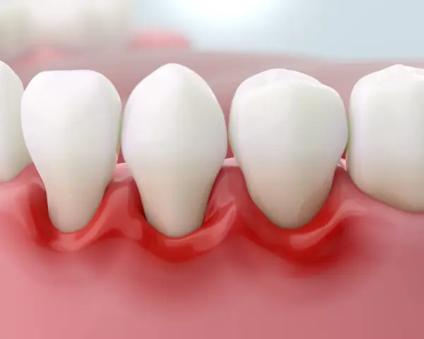 Podrażnione dziąsła: Szybka ulga, leczenie i kiedy do dentysty?