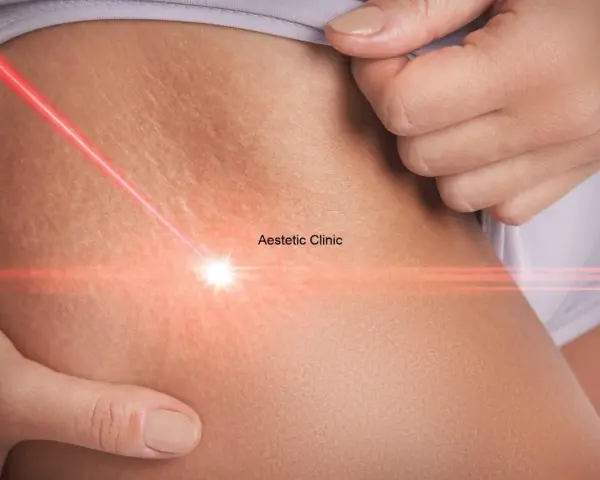 Czerwony promień lasera skierowany na rozstępy na biodrach, symbolizujący zabieg estetyczny.