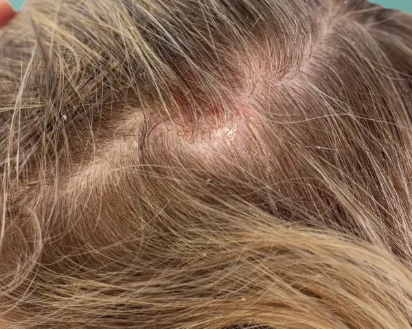Nahaufnahme der Kopfhaut mit Haaren, die einen roten, schuppigen schorf am hinterkopf zeigen.
