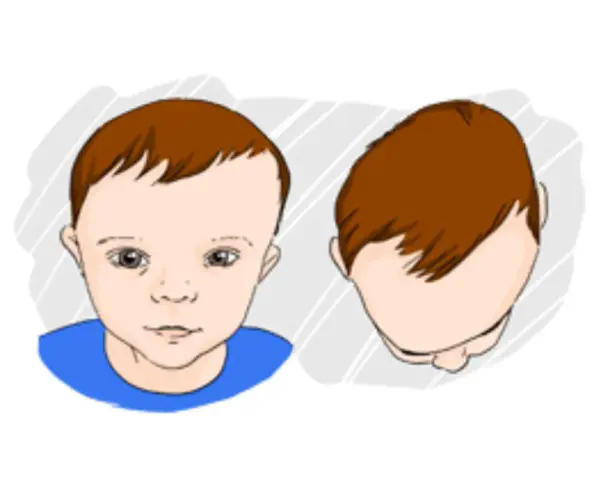 Ilustracja pokazuje niemowlaka z asymetrią główki, co może wskazywać na plagiocefalię.