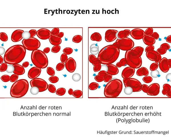 Vergleich von roten Blutkörperchen: Links normal, rechts erhöht (erythrozyten zu hoch). Polyglobulie durch Sauerstoffmangel.