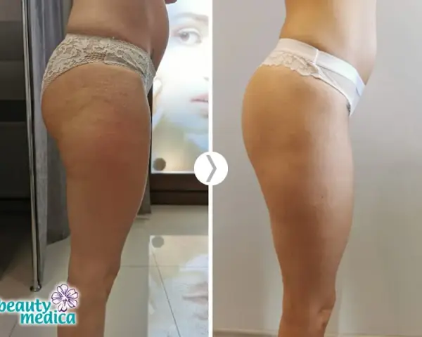 Endermologia: Hit czy Kit? Obiektywna Analiza Efektów i Kosztów
