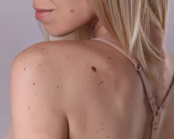 Schulter und Nacken einer Frau mit vielen braunen und schwarzen Flecken auf der Haut.