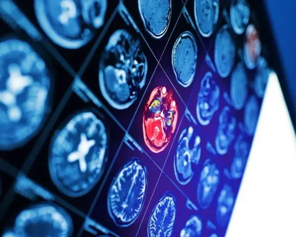 Sekwencja obrazów neurotop z wyróżnionym czerwonym obszarem mózgu, sugerującym nieprawidłowość.
