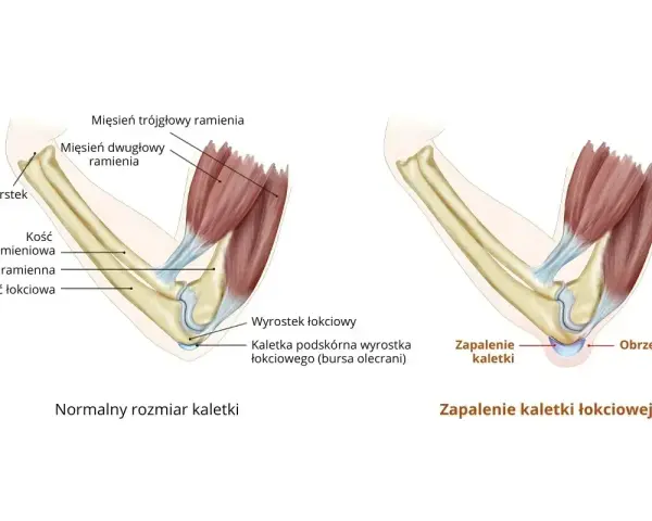 Porównanie zdrowej kaletki łokciowej z jej zapaleniem i obrzękiem. Ilustracja pokazuje anatomię łokcia i skutki zapalenia kaletki łokciowej.