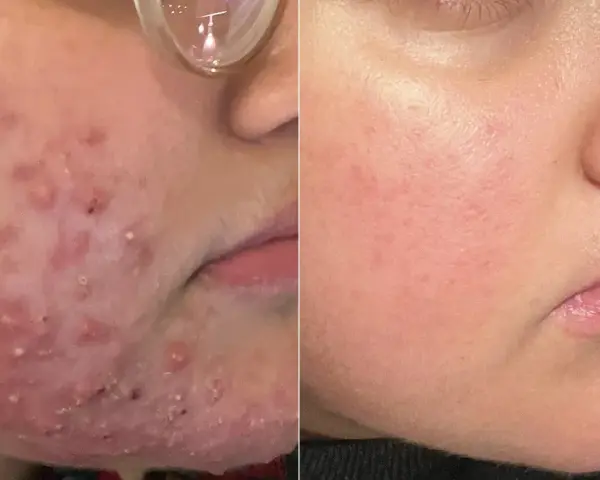 Före- och efterbilder visar en ansiktshud med atopiskt eksem som blivit betydligt bättre.