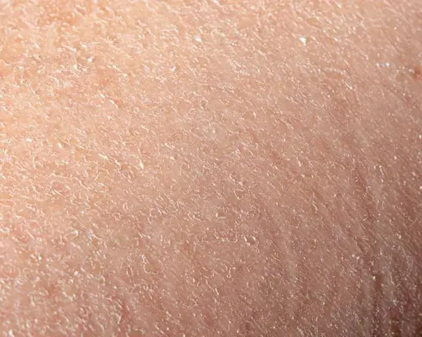 Ursachen und Lösungen für trockene schuppige Gesichtshaut verstehen