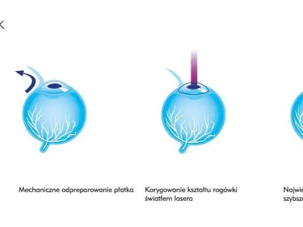 Korekcja krótkowzroczności: Od okularów po laser wybierz mądrze!