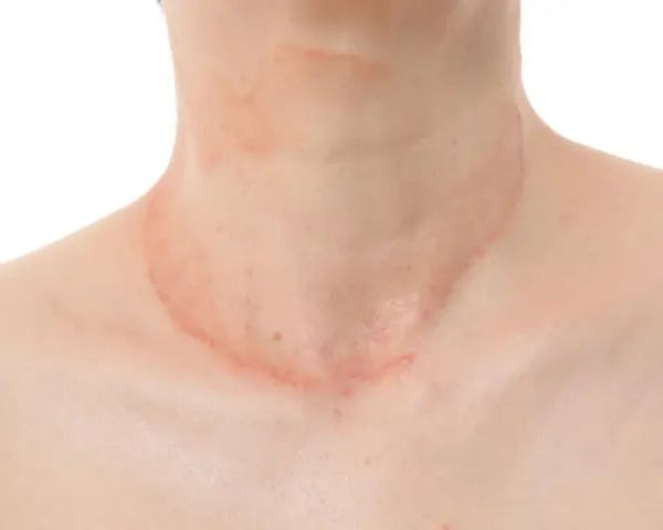 Piel con erupción rojiza y escamosa en el cuello, sugiriendo la presencia de hongos en el cuello.