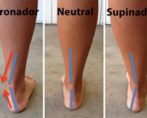 Vista posterior de tres tipos de pisada: pronador, neutral y supinador. El pronador muestra el tobillo inclinado hacia adentro.