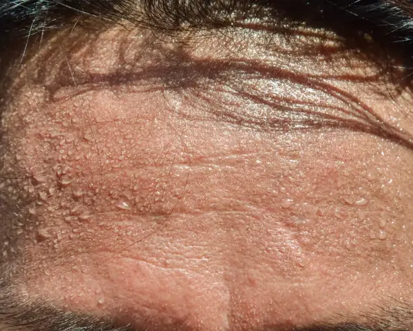 Frente sudorosa con gotas de agua. ¿Buscas trucos para no sudar por la cabeza?