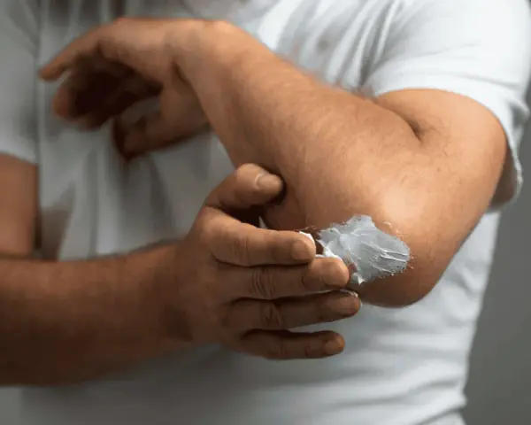 Mężczyzna smaruje łokieć kremem. Szukasz najlepszej kliniki leczenia łuszczycy?