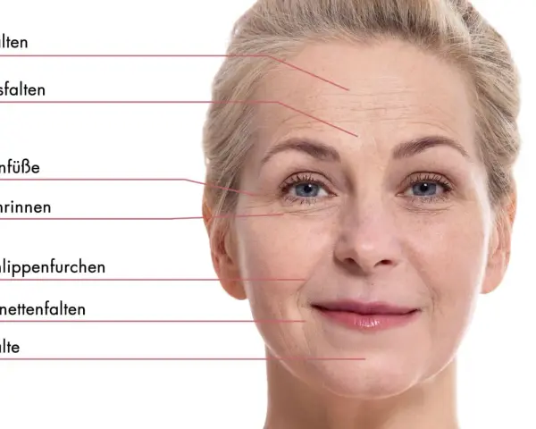 Nahaufnahme einer Frau mit Stirnfalten, Zornesfalten und Krähenfüßen. Selbst mit 20 Jahren können erste Zeichen der Hautalterung sichtbar werden.