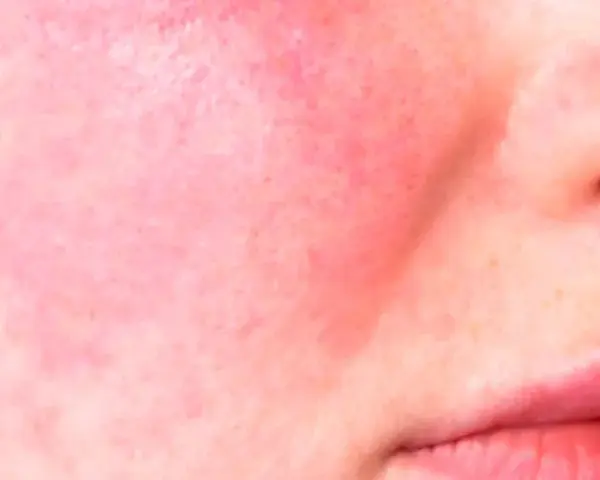 Primo piano di pelle con rosacea, arrossamento diffuso e piccoli vasi sanguigni visibili sulle guance e sul naso.