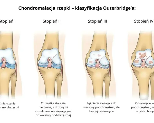 Ilustracja pokazuje cztery stopnie chondromalacji rzepki wg Outerbridge'a: od zmiękczenia chrząstki do odsłonięcia kości.