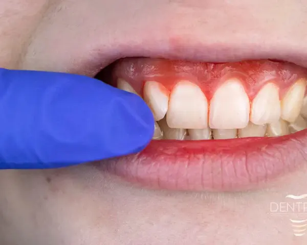 Widoczne są białe zęby i zaczerwienione, krwawiące dziąsła. Niebieska rękawiczka dentystyczna delikatnie odsłania problem.