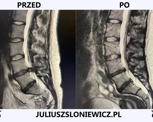 Rwa kulszowa: Zrozum objawy, znajdź ulgę i pokonaj ból!