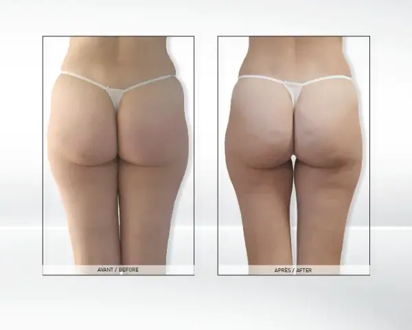 Endermologia: Ile cm stracisz? Realne efekty i wskazówki