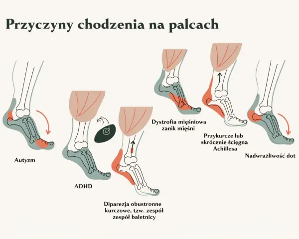 Ilustracja pokazuje przyczyny chodzenia na palcach, w tym autyzm, ADHD, dystrofię mięśniową, przykurcze ścięgna Achillesa i nadwrażliwość dotykową.