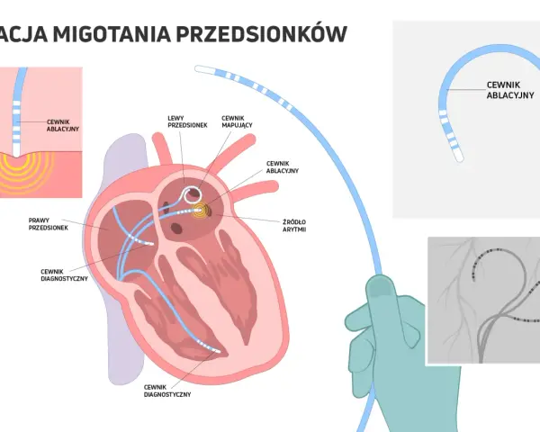 Ilustracja wyjaśnia, co to ablacja migotania przedsionków. Pokazuje cewniki diagnostyczne i ablacyjne w sercu, lokalizujące źródło arytmii.