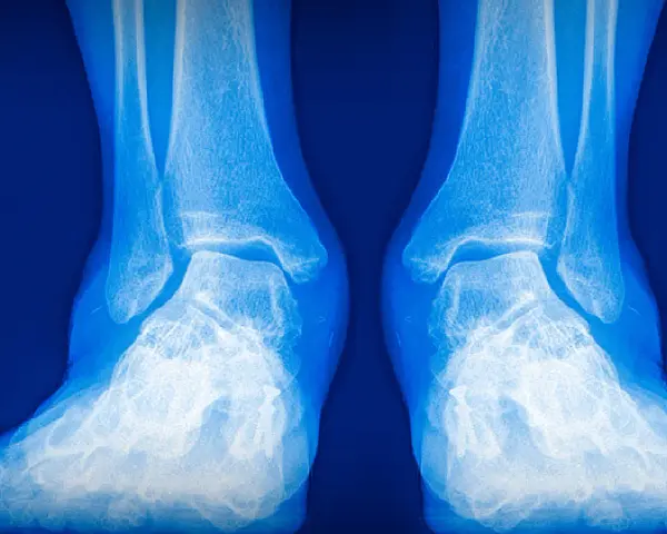 Radiografía de tobillos y pies. La imagen muestra la anatomía ósea, útil para evaluar condiciones como el pie valgo y la elección de zapatos adecuados.