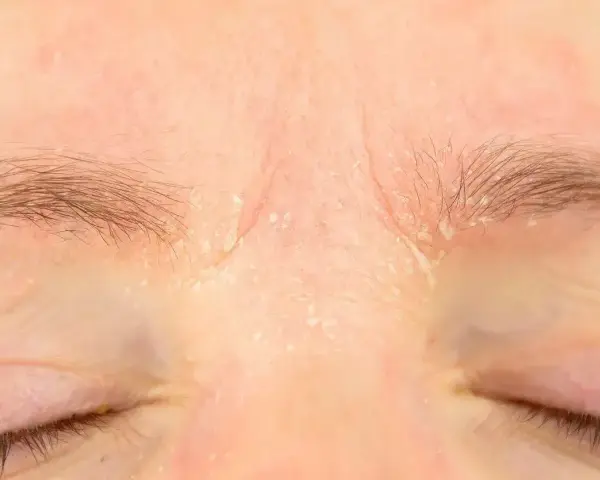 Skóra nad oczami jest zaczerwieniona i łuszczy się, co może być jednym z retinol skutki uboczne.