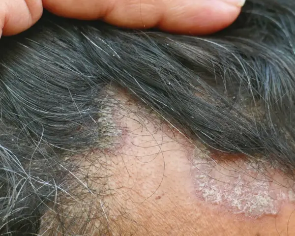 Juckende Kopfhaut mit schuppigen Stellen und Haarausfall. Eine Hand berührt die betroffenen Stellen.