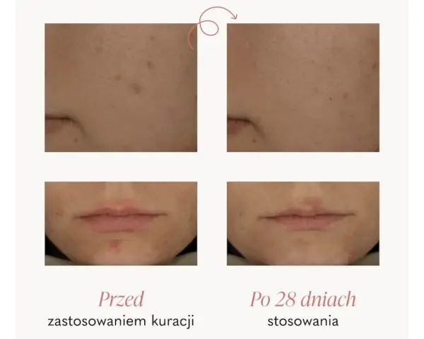 Przed i po 28 dniach stosowania Twojej Kaya kuracji złuszczającej: widoczna poprawa cery, zmniejszenie porów i niedoskonałości.