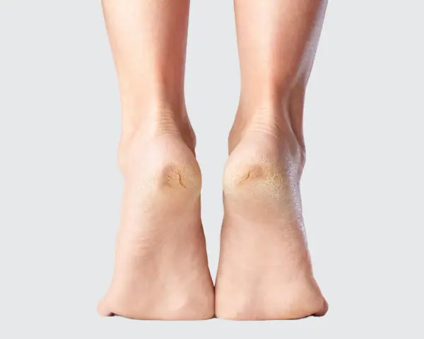 Talons secs et craquelés, un signe qu'il est temps d'envisager un durillon pied traitement naturel pour retrouver douceur et confort.
