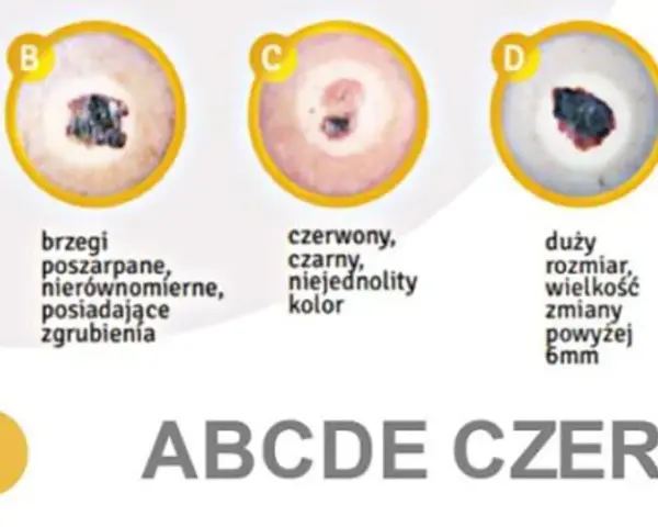 ABCDE czerniaka: asymetria, brzegi, czerwony/czarny kolor, duży rozmiar, ewolucja. Obrazki pokazują, jak wygląda czerniak.