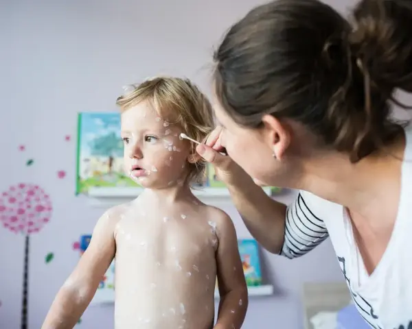 Madre aplica crema a su bebé con miliaria. El niño rubio tiene la piel cubierta de pequeñas erupciones blancas.