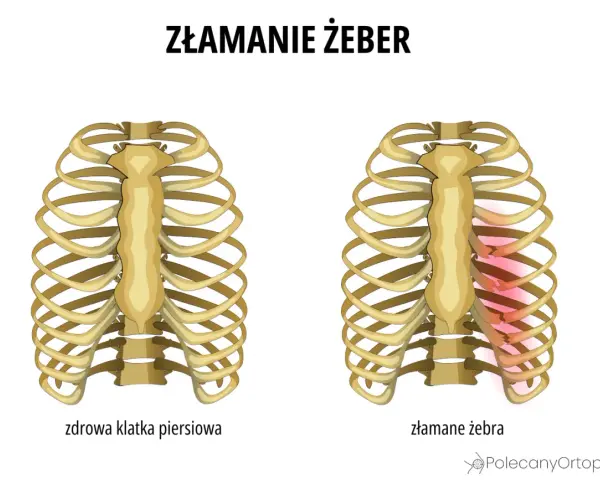 Dwie klatki piersiowe: zdrowa i z widocznymi złamaniami żeber zaznaczonymi na czerwono.
