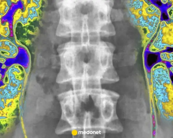 Kolorowa scyntygrafia kości pokazuje nerki i kręgosłup. Obraz uwidacznia obszary o różnej aktywności metabolicznej.