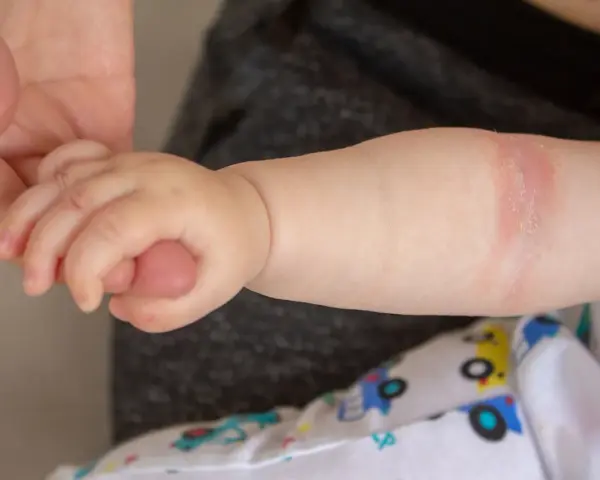Babyarm mit geröteter Stelle, die auf einen Hautpilz am Po hindeuten könnte.