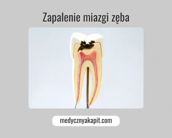Model zęba ukazujący próchnicę i zapalenie miazgi.