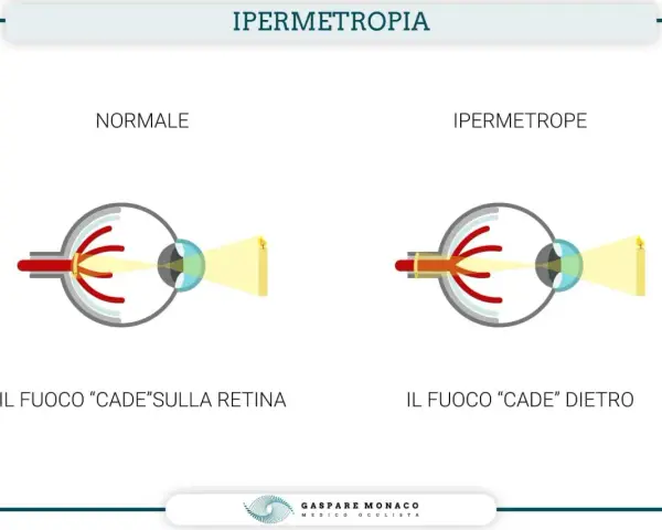 Confronto tra occhio normale e occhio ipermetrope. Nell'ipermetropia lieve, il fuoco cade dietro la retina, rendendo sfocati gli oggetti vicini.
