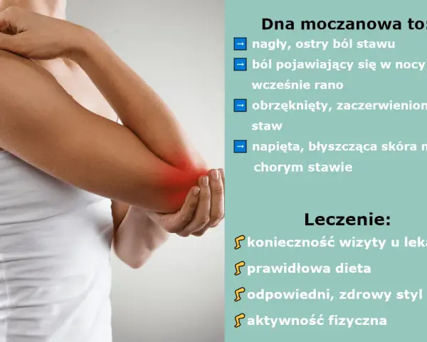 Dna moczanowa objawia się nagłym bólem stawu, obrzękiem i zaczerwienieniem. Leczenie obejmuje wizytę u lekarza, dietę i aktywność fizyczną.