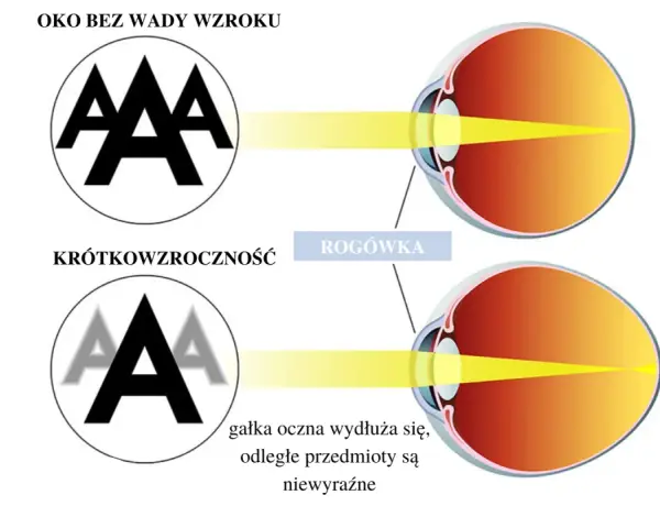 Ilustracja porównująca oko zdrowe z krótkowzrocznym, pokazująca skupienie światła.