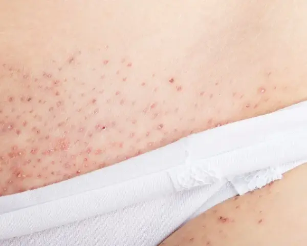 Närbild på irriterad hud efter rakning, med små röda prickar och knottror.