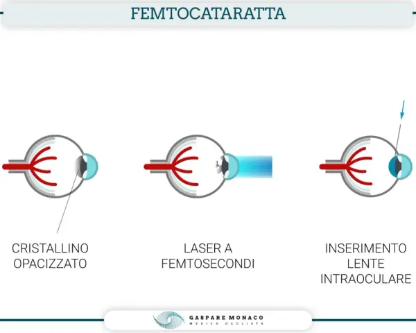 Chirurgia della cataratta con laser: illustra cristallino opacizzato, laser a femtosecondi e inserimento lente intraoculare. Valutare sempre le controindicazioni.