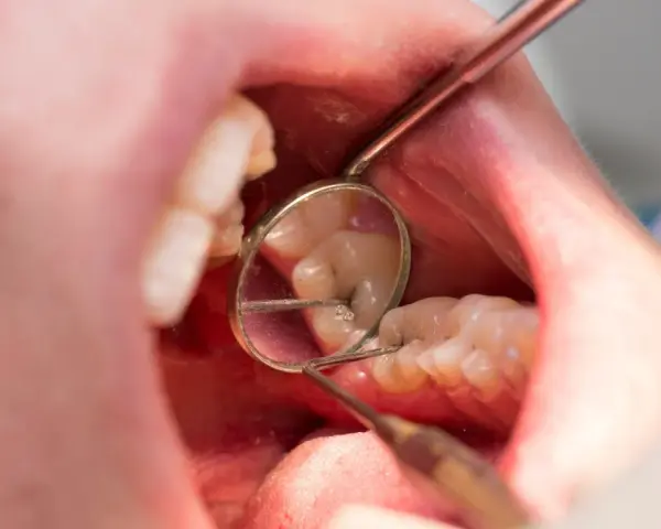 Dentysta bada zęby, widoczne są oznaki chorób zębów, takie jak ubytek.