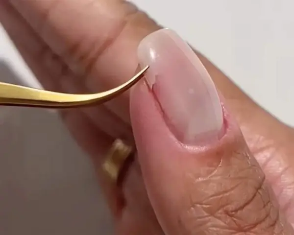 Pince dorée retirant délicatement un ongle arraché, révélant la peau sensible.