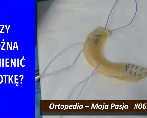 Implant łąkotki NFZ. Czy można wymienić łąkotkę? Ortopedia – Moja Pasja #065.