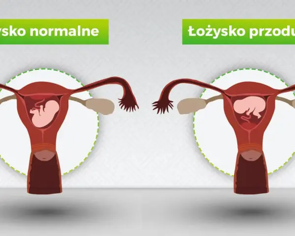 Porównanie: łożysko normalne vs łożysko przodujące. Po prawej stronie widoczna macica z płodem i łożyskiem przodującym, blokującym szyjkę macicy.