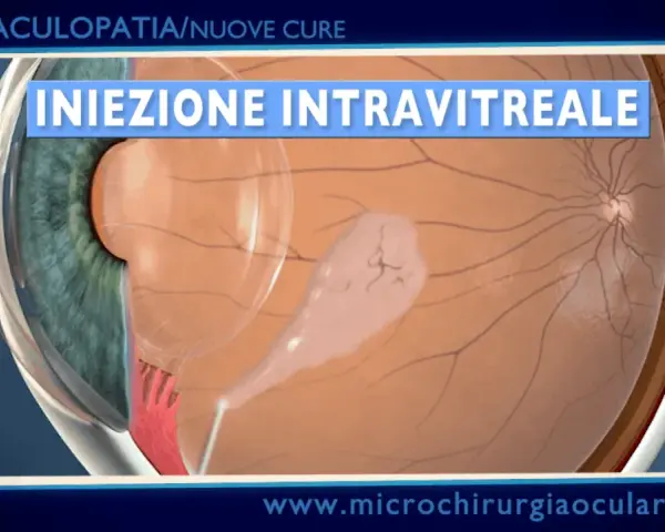 Iniezione intravitreale per trattare l'emorragia maculare. La macula, colpita da un'anomalia, riceve il farmaco.