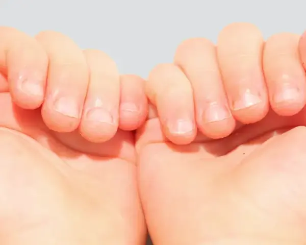 Mains d'enfant montrant des ongles rongés, avec des cuticules irrégulières et des bords d'ongles abîmés.