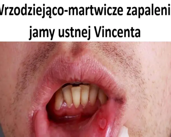 Wrzodziejące zapalenie jamy ustnej Vincenta. Widoczne owrzodzenie na wardze dolnej, wymagające leczenia.