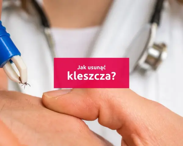 Usuwanie kleszcza pęsetą z ludzkiej skóry.